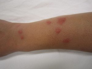 bedbugs beten